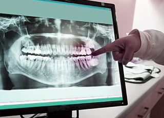 Panoramic dental x-ray on computer